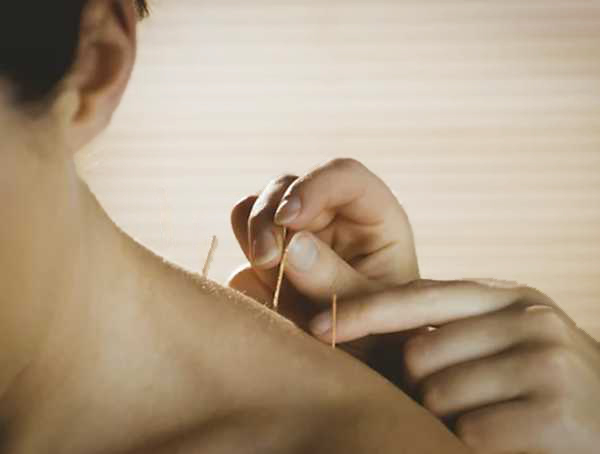 acupuncture on shoulder